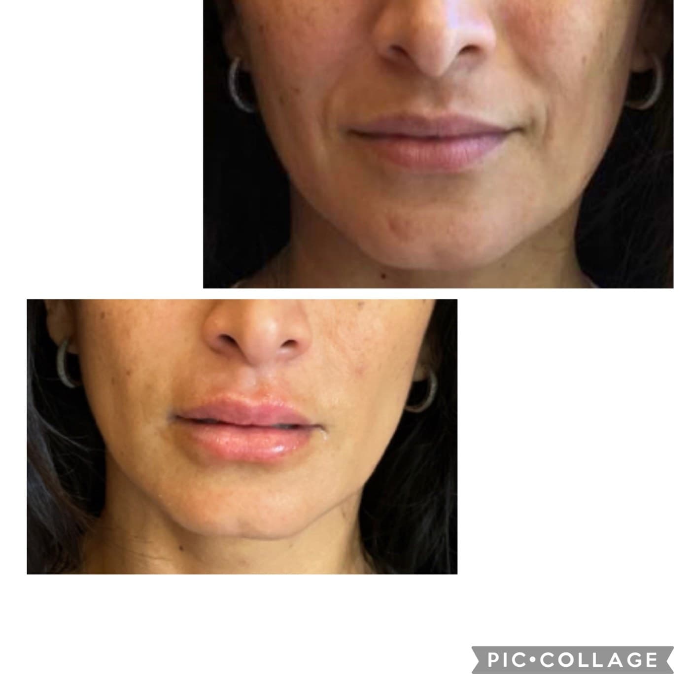 Lips before and after — real Healinque patient, shared with written consent