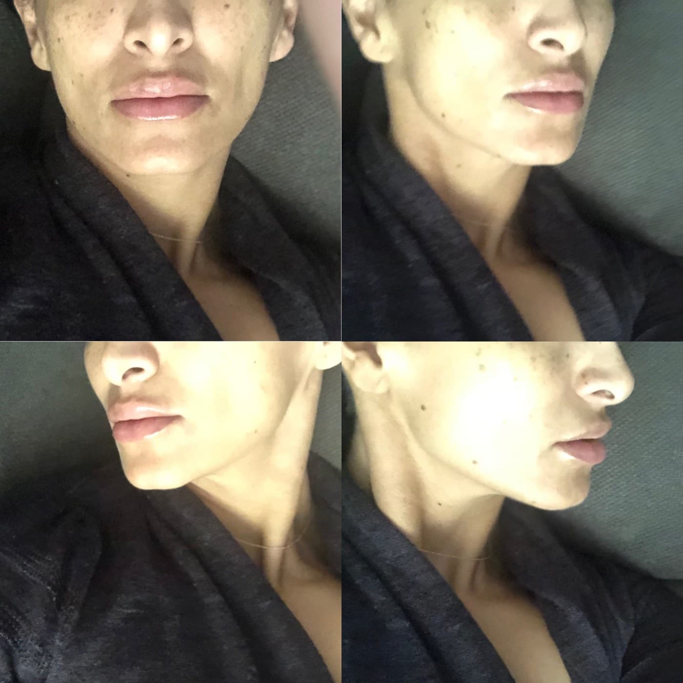 Lips before and after — real Healinque patient, shared with written consent
